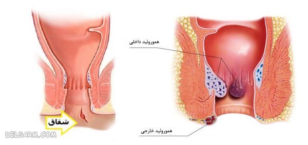 فرق فیشرو هموروئید