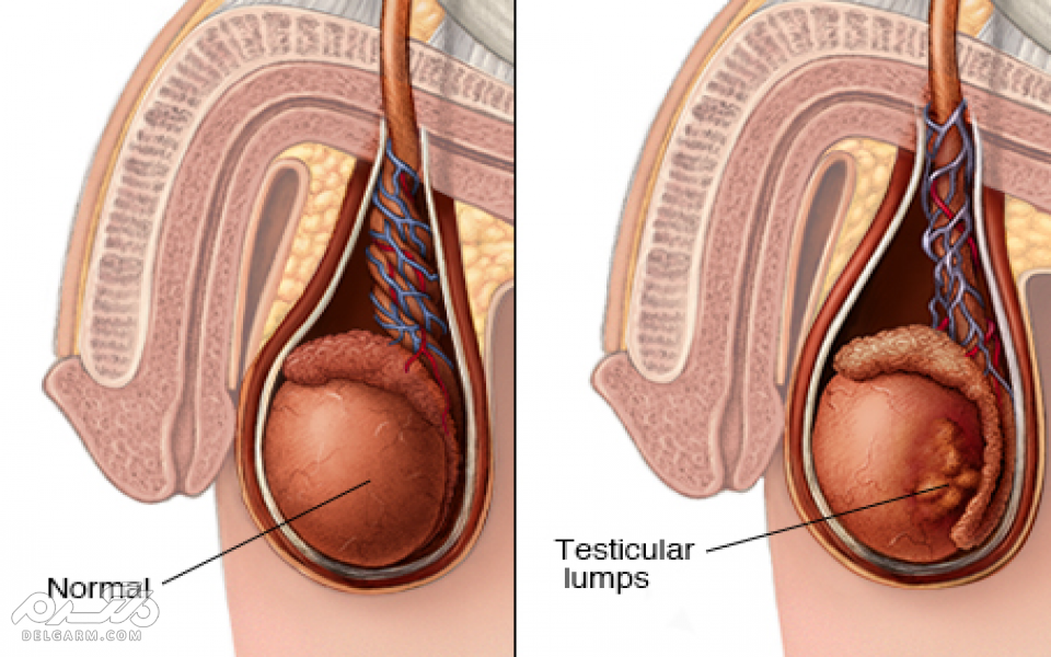 تشخیص سرطان بیضه