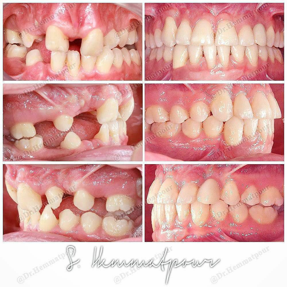 حرکات دندان در دوران درمان ارتودنسی چگونه انجام میشود؟