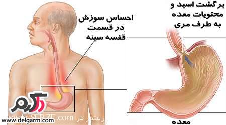 عوارض سوزش سر دل چیست؟