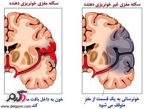 انواع سکته مغزی