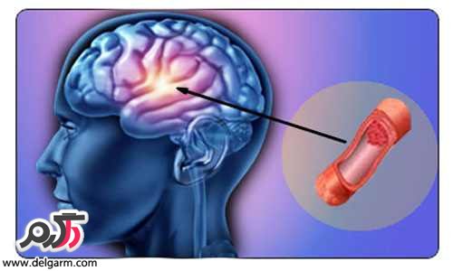 درمان سکته مغزی