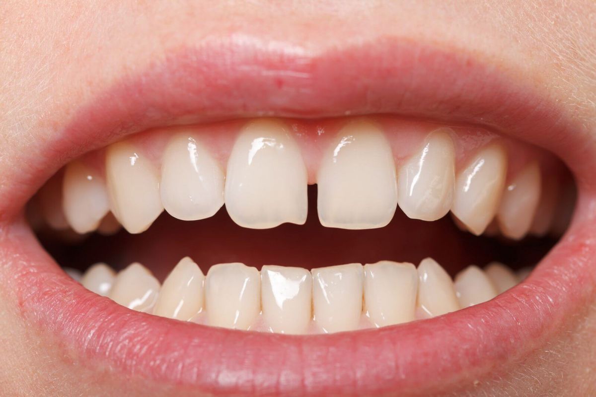 فاصله بین دندان ها را درمان کنید