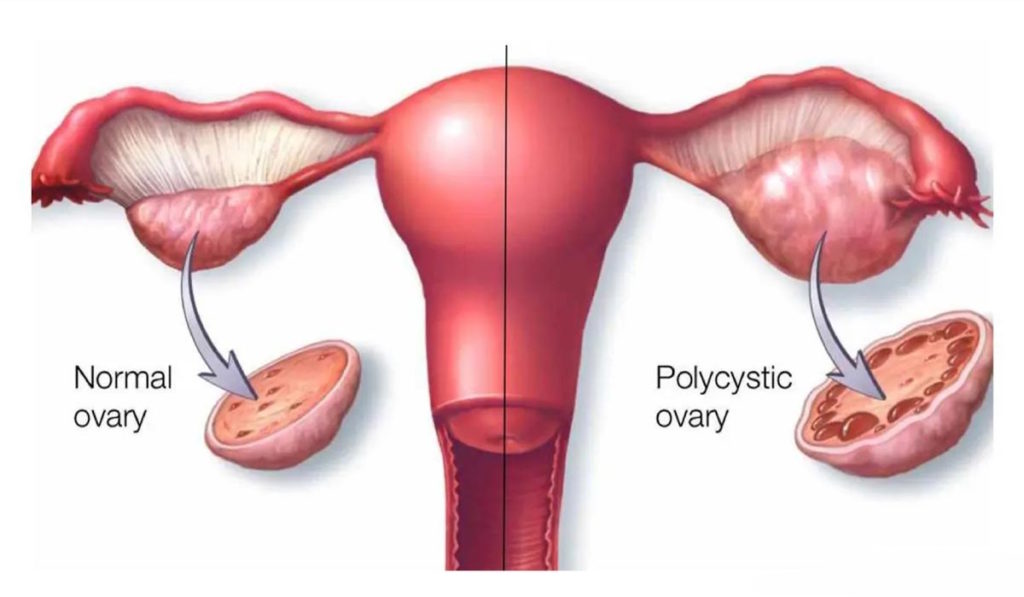 کیست تخمدان چیست و چگونه درمان می‌شود؟